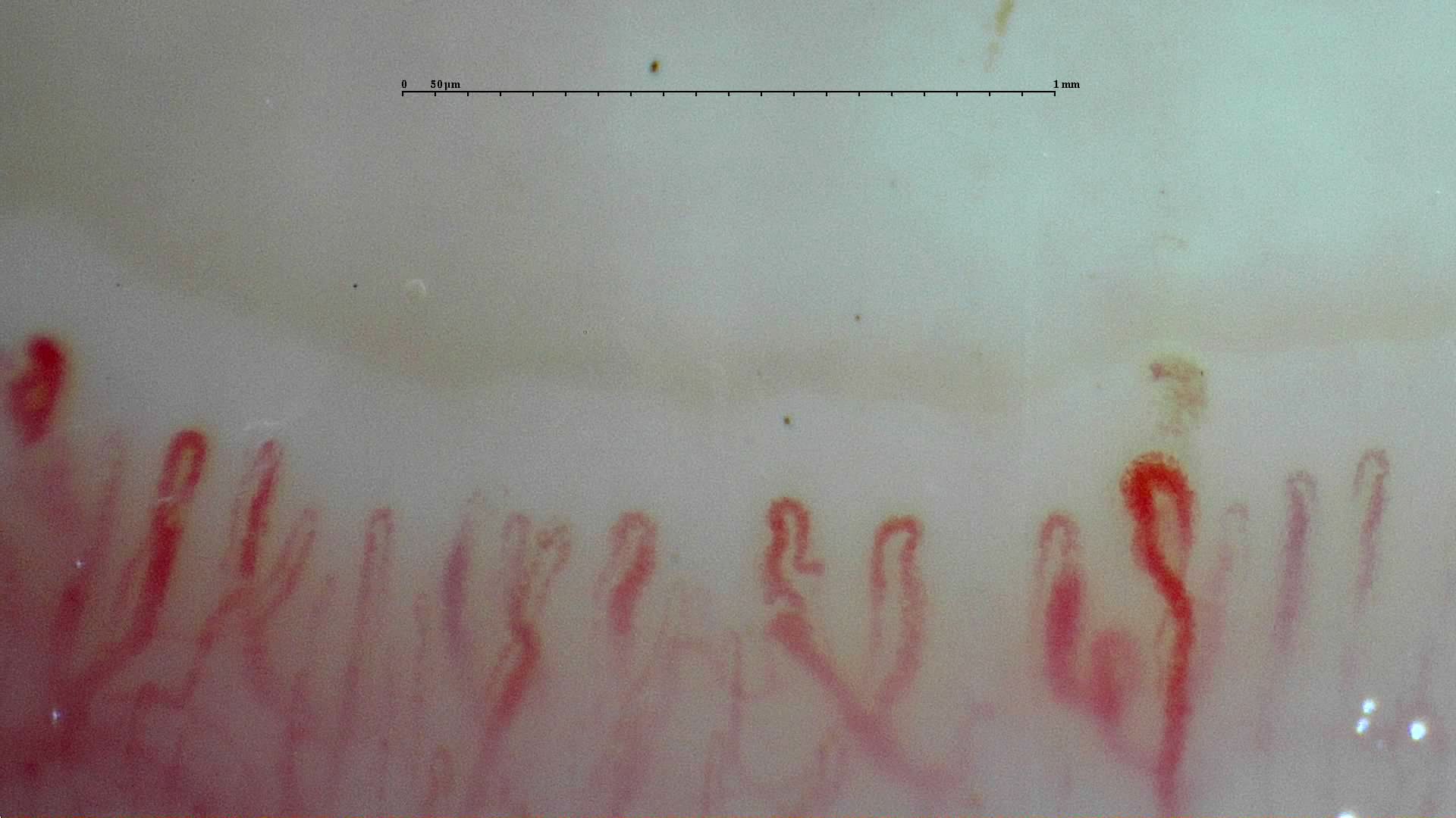 An enlarged tortuous capillary on the right, beside finer loops. A small brown deposit just above it may represent a microhemorrhage.