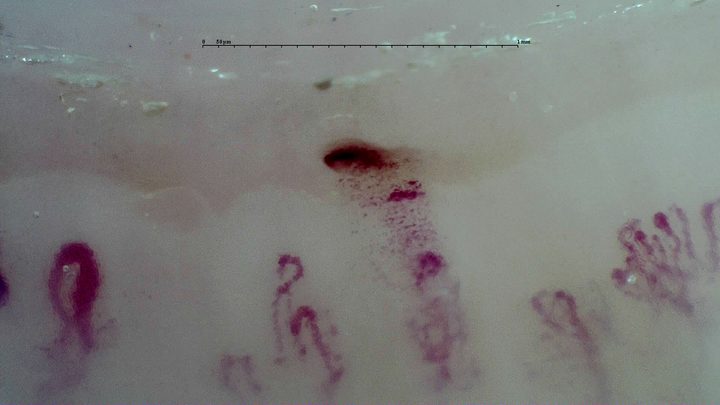 A giant-appearing oval capillary on the left and a small branching capillary on the right. Several hemorrhagic deposits lie near the center.
