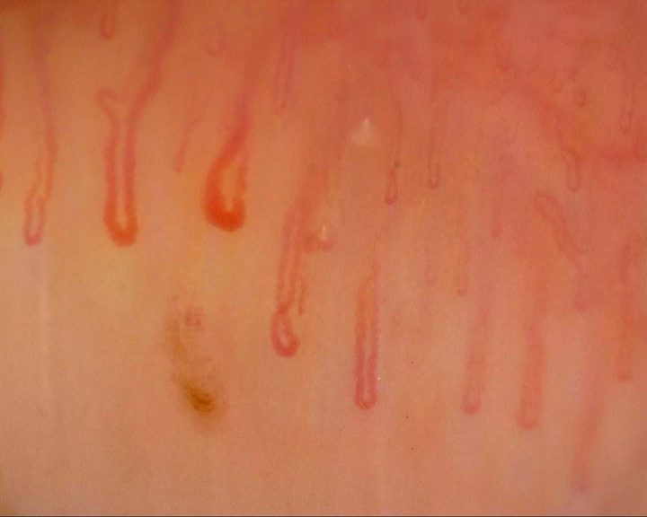 Two giant-appearing capillaries near the left-center, beside longer fine hairpin loops. A brown deposit compatible with a microhemorrhage lies below the row.