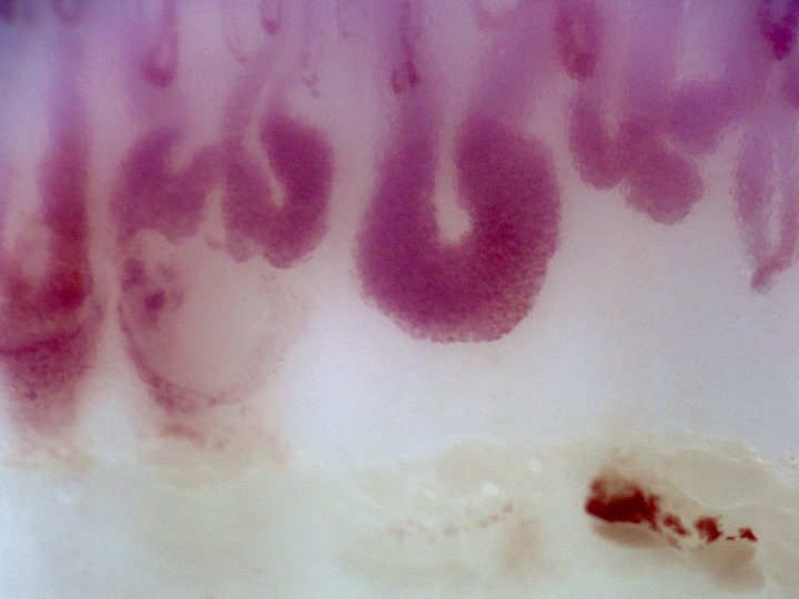 Several giant-appearing capillaries with thick rounded apices and broad limbs. Microhemorrhages lie below and to the right of the central loop.