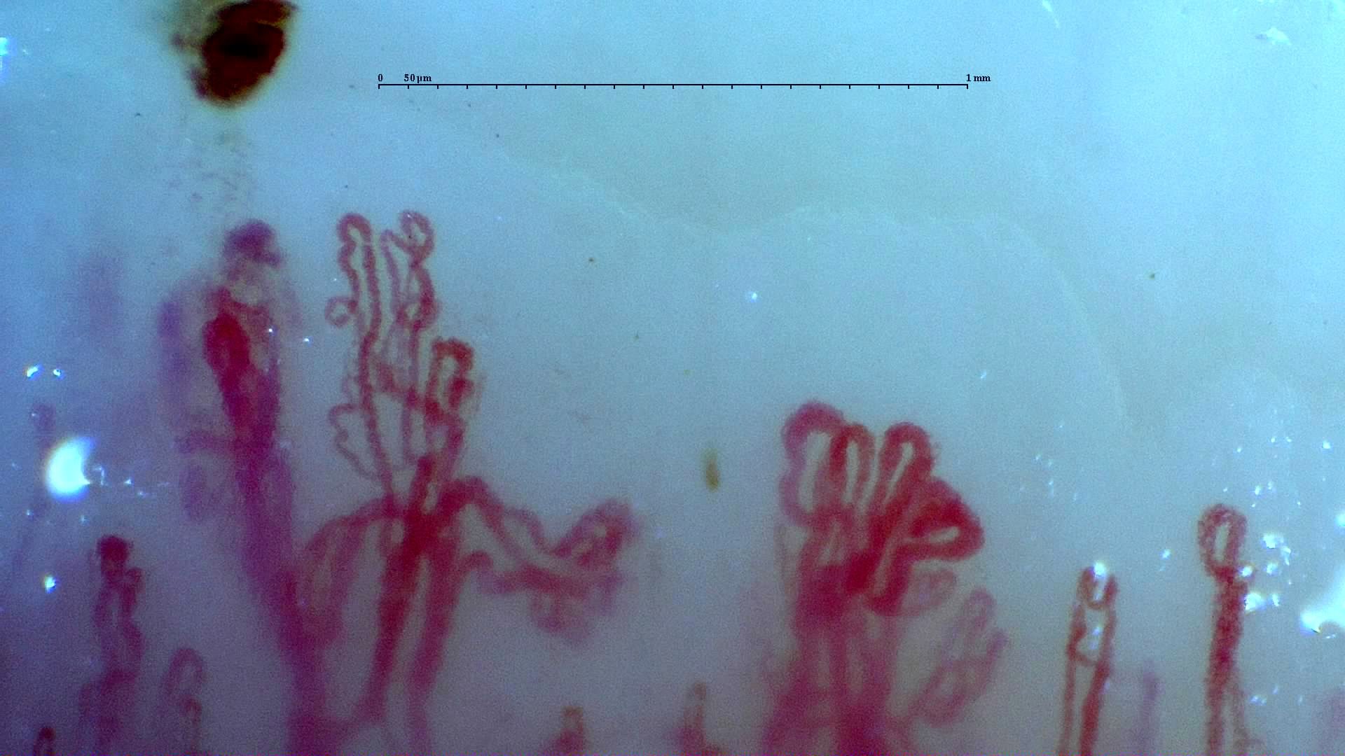 Two branching capillaries with multiple rounded apices and lateral branches. A dense dark hemorrhagic deposit lies above the left capillary.