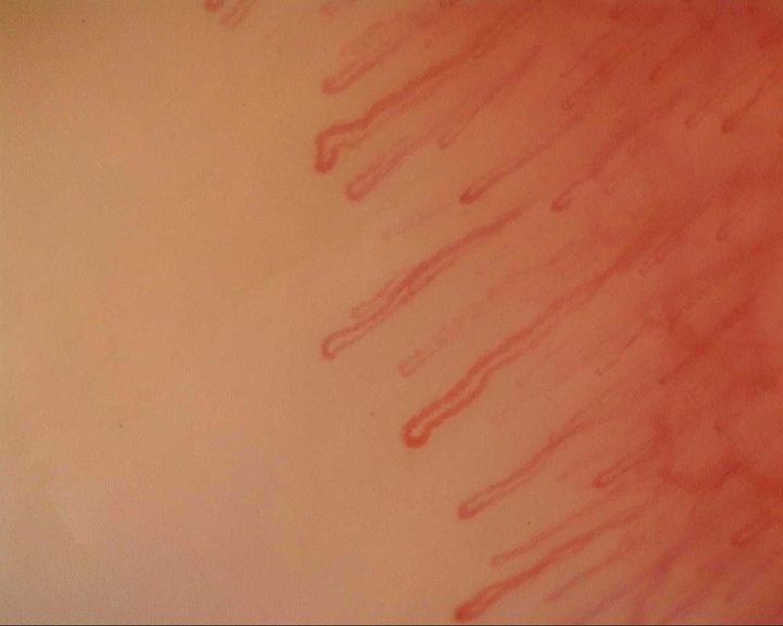 Long hairpin capillaries mixed with thicker, mildly tortuous loops.