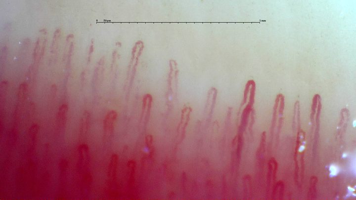 Hairpin capillaries of different visible lengths. The loops on the right are more clearly defined.