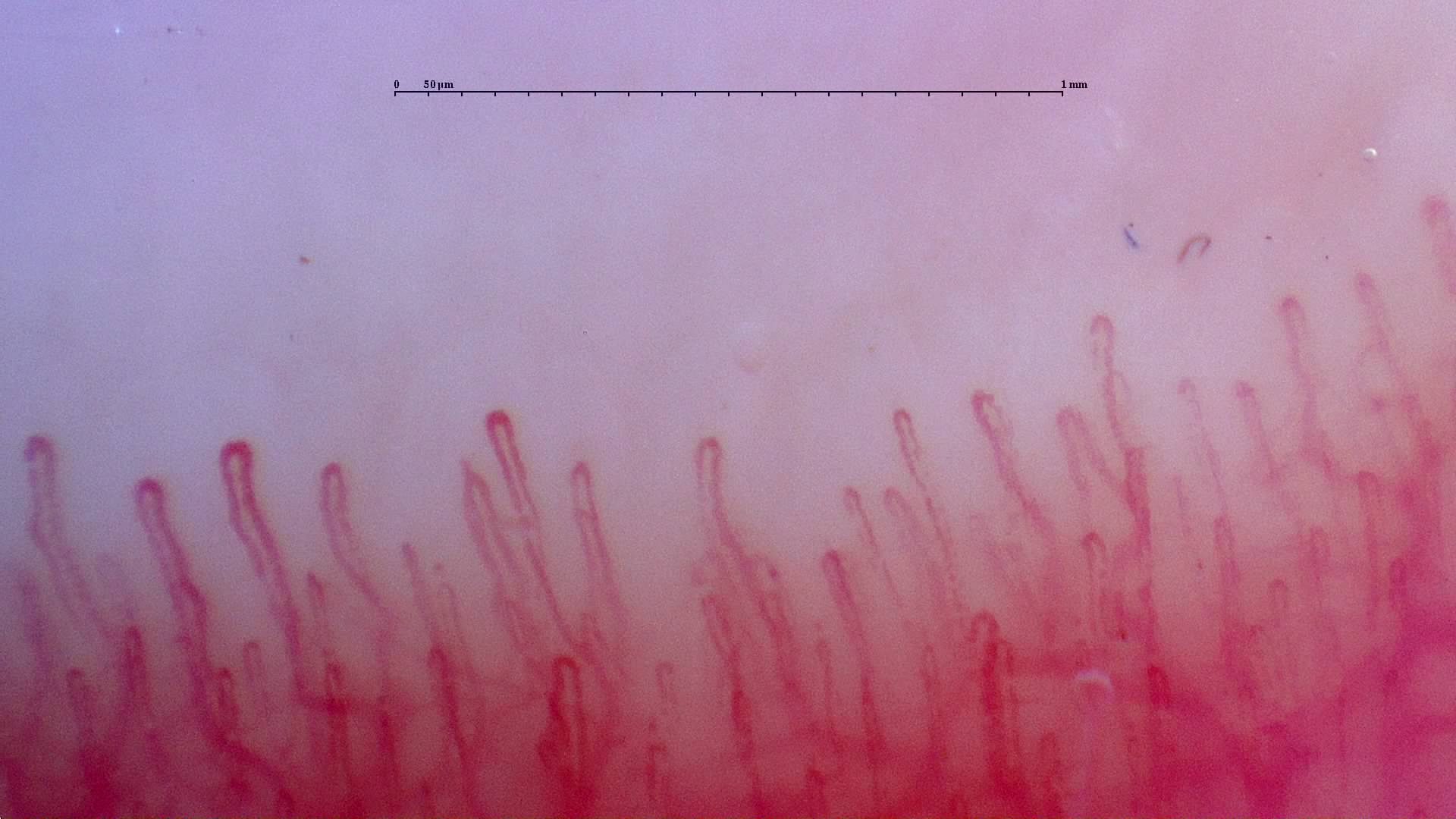 Long hairpin capillaries with rounded apices and variable widths. The deeper vascular plexus is visible.