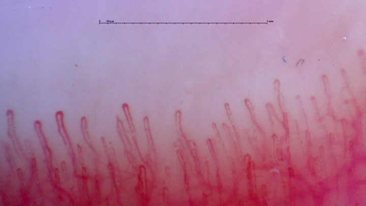 Long hairpin capillaries with rounded apices and variable widths. The deeper vascular plexus is visible.