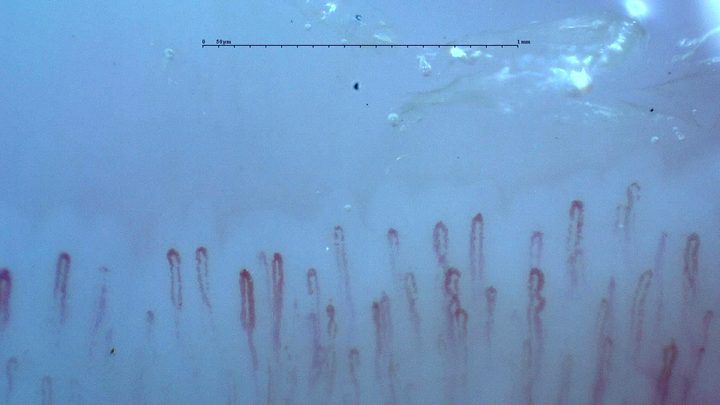 Hairpin capillaries with rounded apices and mild tortuosity in some limbs.