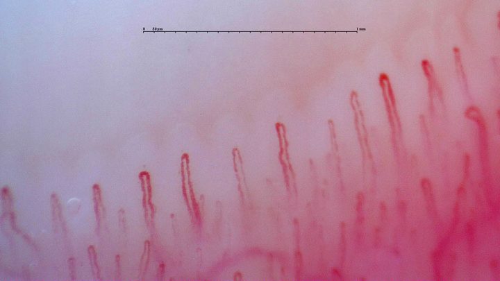 Mostly simple hairpin capillaries, with some wider loops and a visible transverse vessel in the deeper plane.