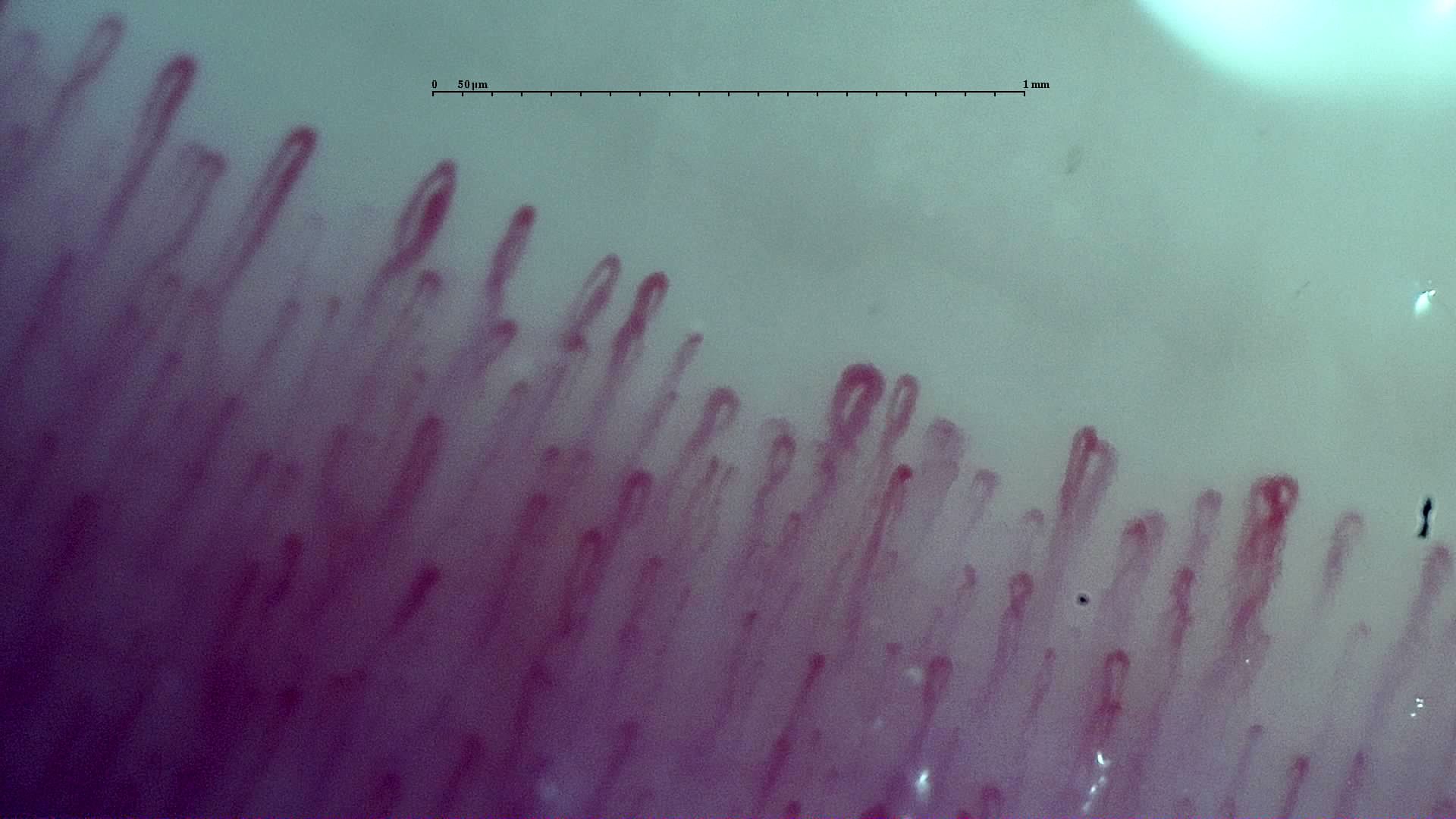 Broad and fine hairpin capillaries lie close together, with some overlapping apices.