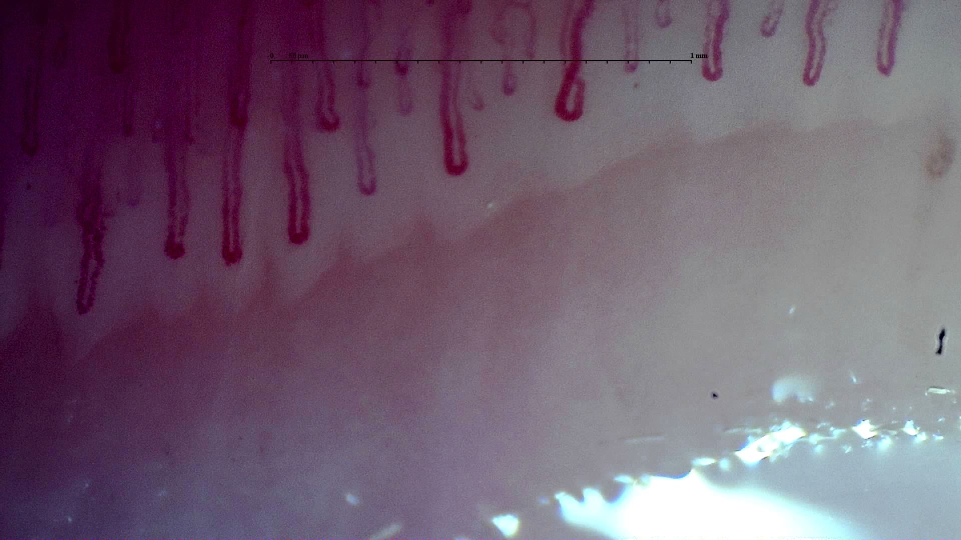 Broad elongated hairpin capillaries with mild tortuosity in some limbs.
