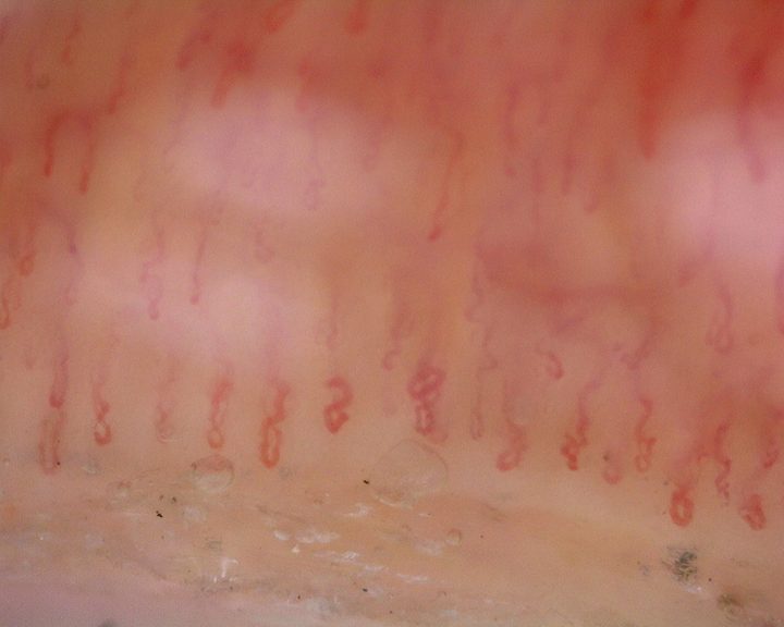 Several coiled and crossed capillaries, including figure-of-eight loops.
