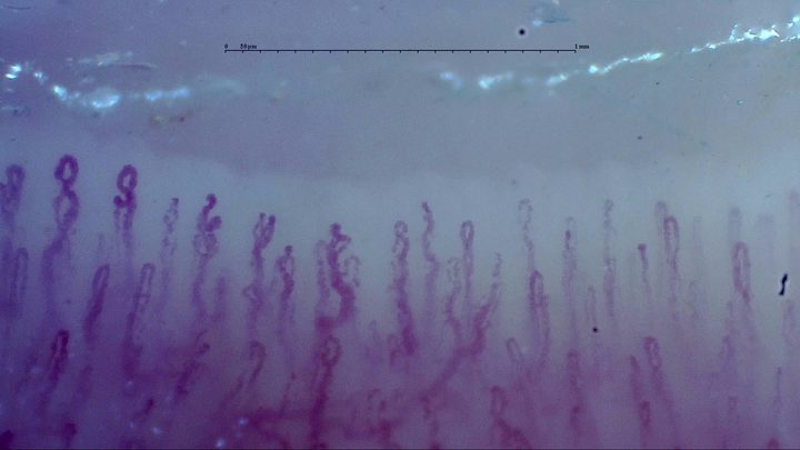 Crossed capillaries with figure-of-eight shapes on the left and tortuous limbs in the center. Simpler hairpins lie to the right.