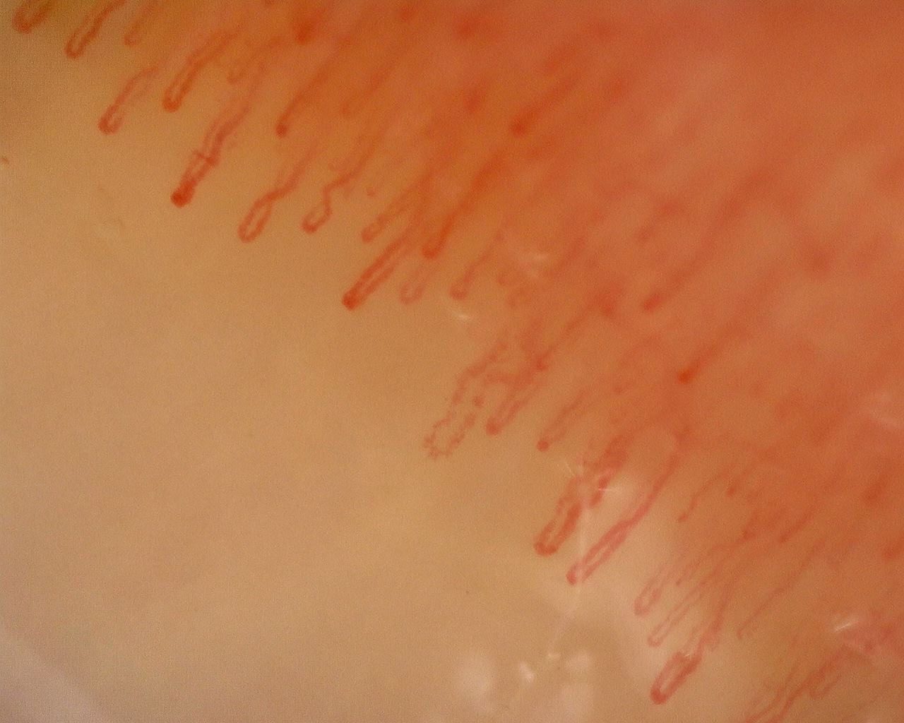 Fine and broader hairpin capillaries with occasional mild bends, especially in the center.