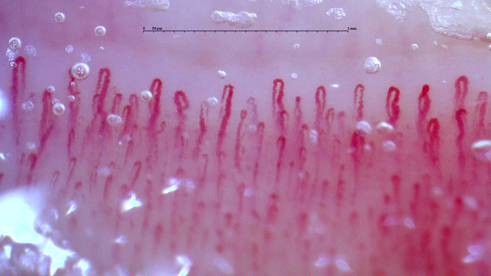 Enlarged capillaries with uneven limb thickness, especially on the right. Bubbles obscure parts of several loops.
