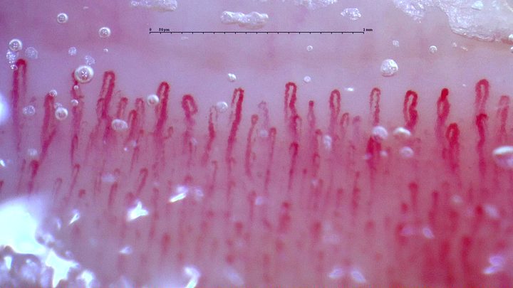 Enlarged capillaries with uneven limb thickness, especially on the right. Bubbles obscure parts of several loops.