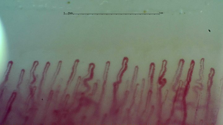 Broad capillaries with rounded apices and marked lateral bends in their limbs, beside straighter hairpin loops.