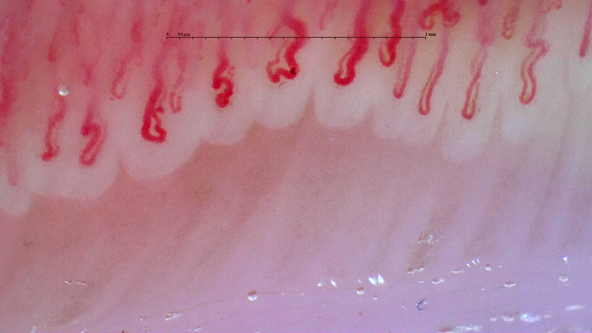 Broad capillaries with hooked and folded apices, mixed with narrower open hairpin loops.