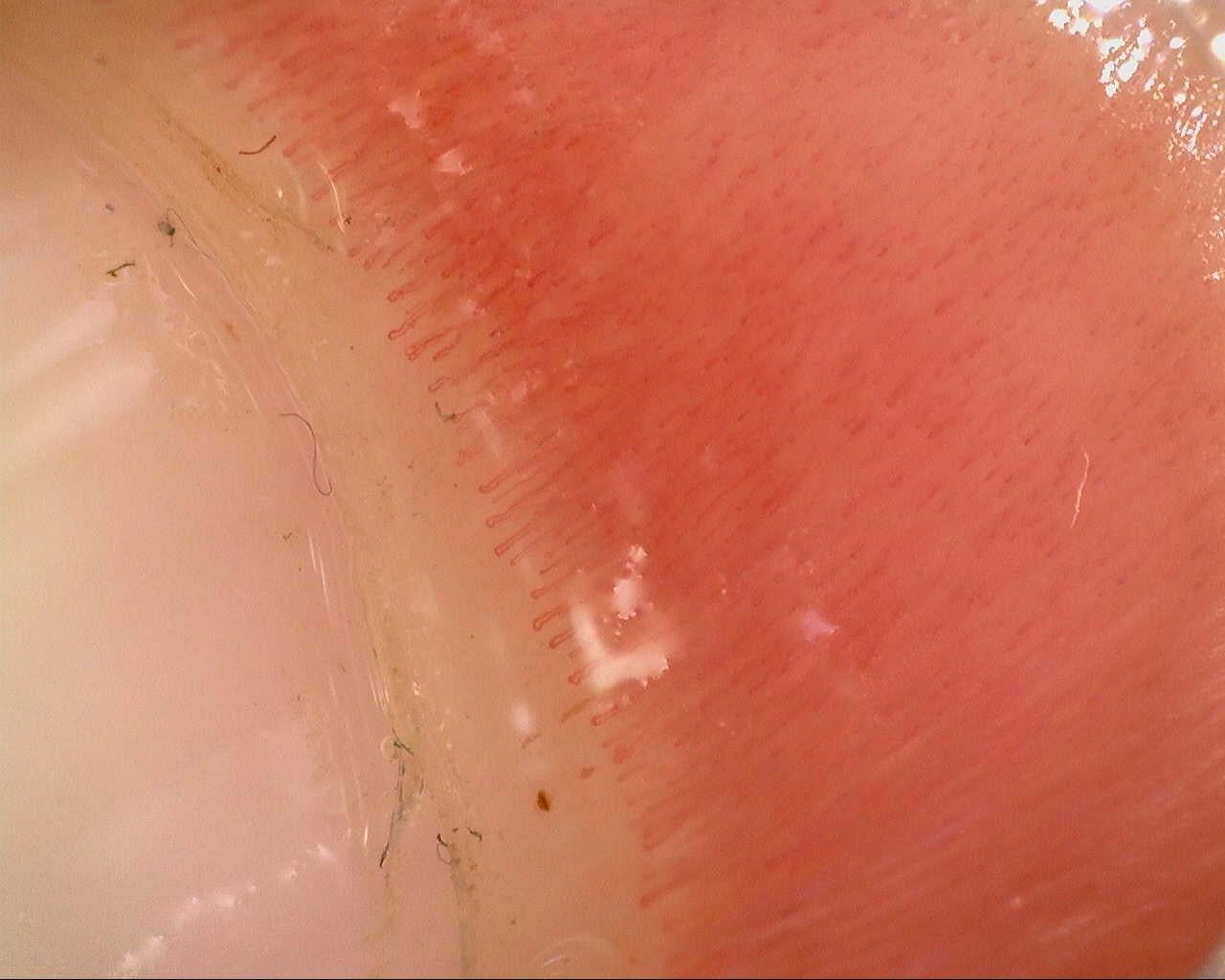 Field with magnification too low to assess the distal capillary row