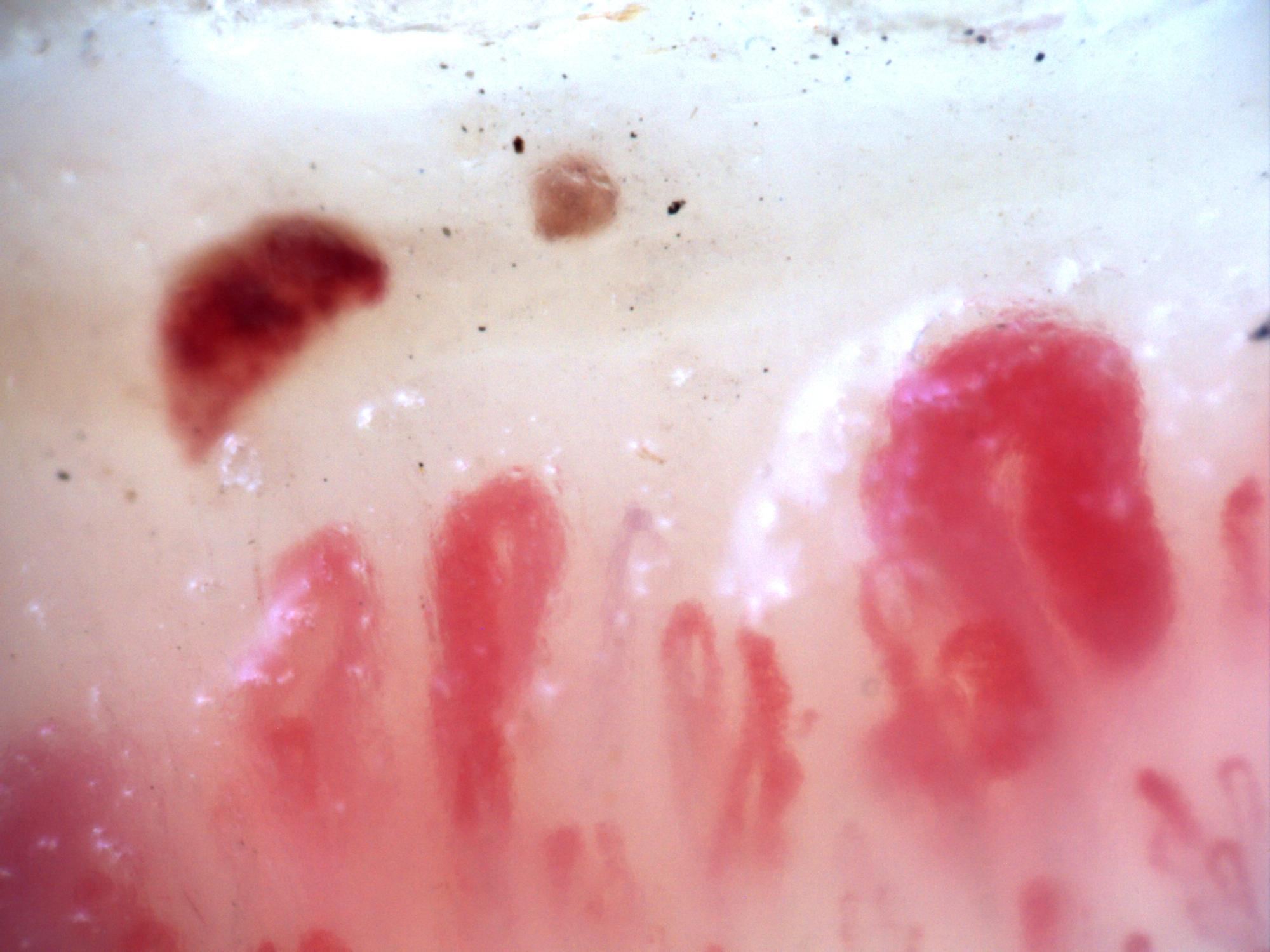 Abnormal nailfold capillaroscopy with scleroderma-pattern features.