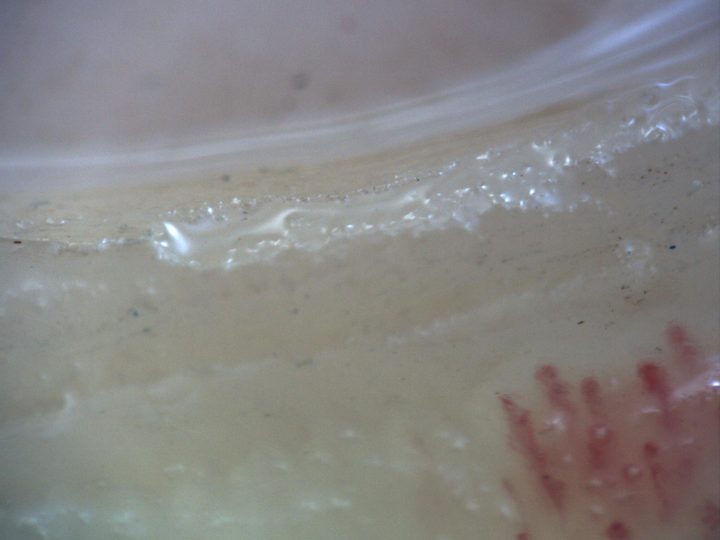 200x capillaroscopy field with disappearance of the capillary bed on the left margin due to excessive pressure on the nail