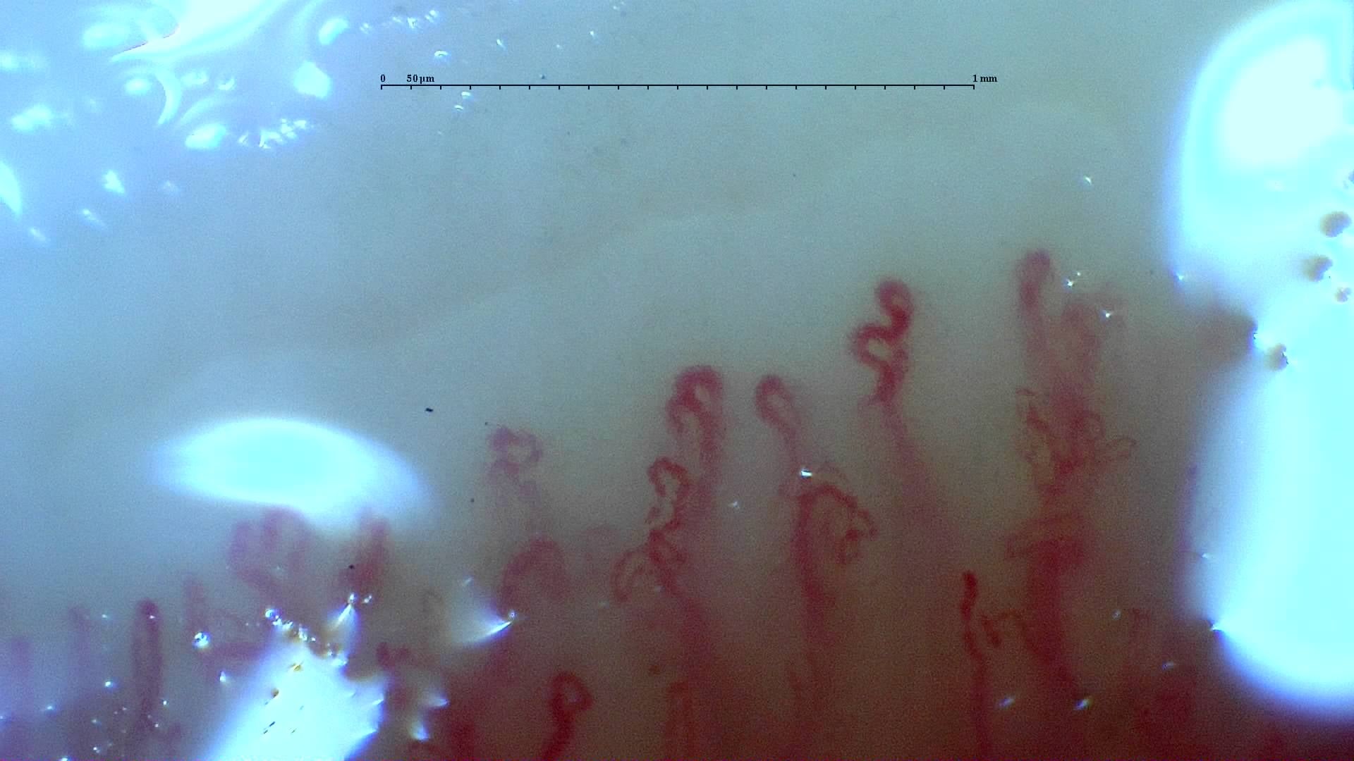 Nailfold capillaroscopy: left little finger, field a. Mixed Connective Tissue Disease with an Unclassifiable Scleroderma-Like Pattern.