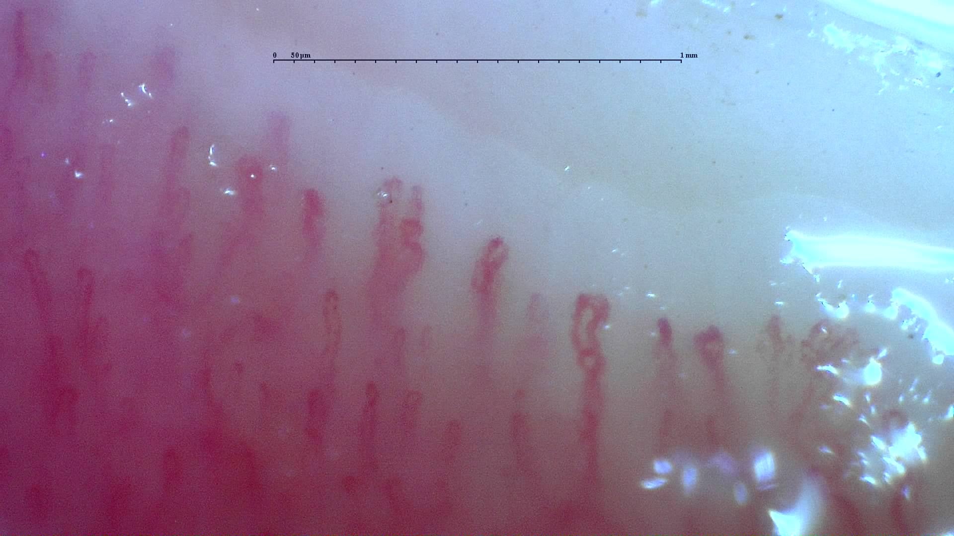 Nailfold capillaroscopy: right little finger, field d. Mixed Connective Tissue Disease with an Unclassifiable Scleroderma-Like Pattern.