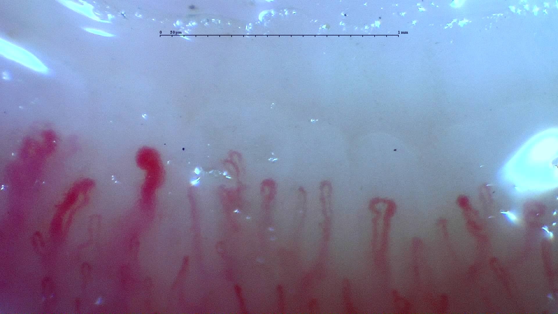 Nailfold capillaroscopy: left little finger, field d. Mixed Connective Tissue Disease with an Unclassifiable Scleroderma-Like Pattern.