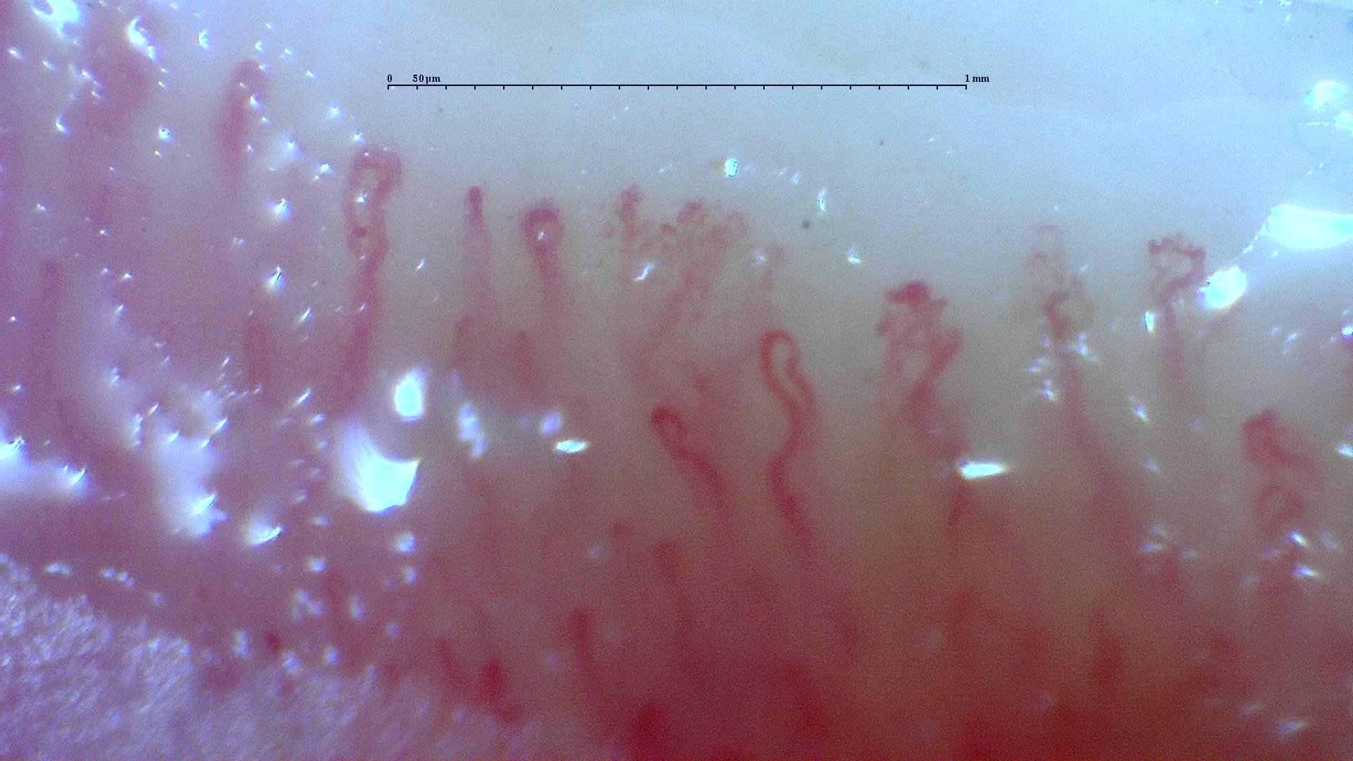 Nailfold capillaroscopy: right little finger, field c. Mixed Connective Tissue Disease with an Unclassifiable Scleroderma-Like Pattern.