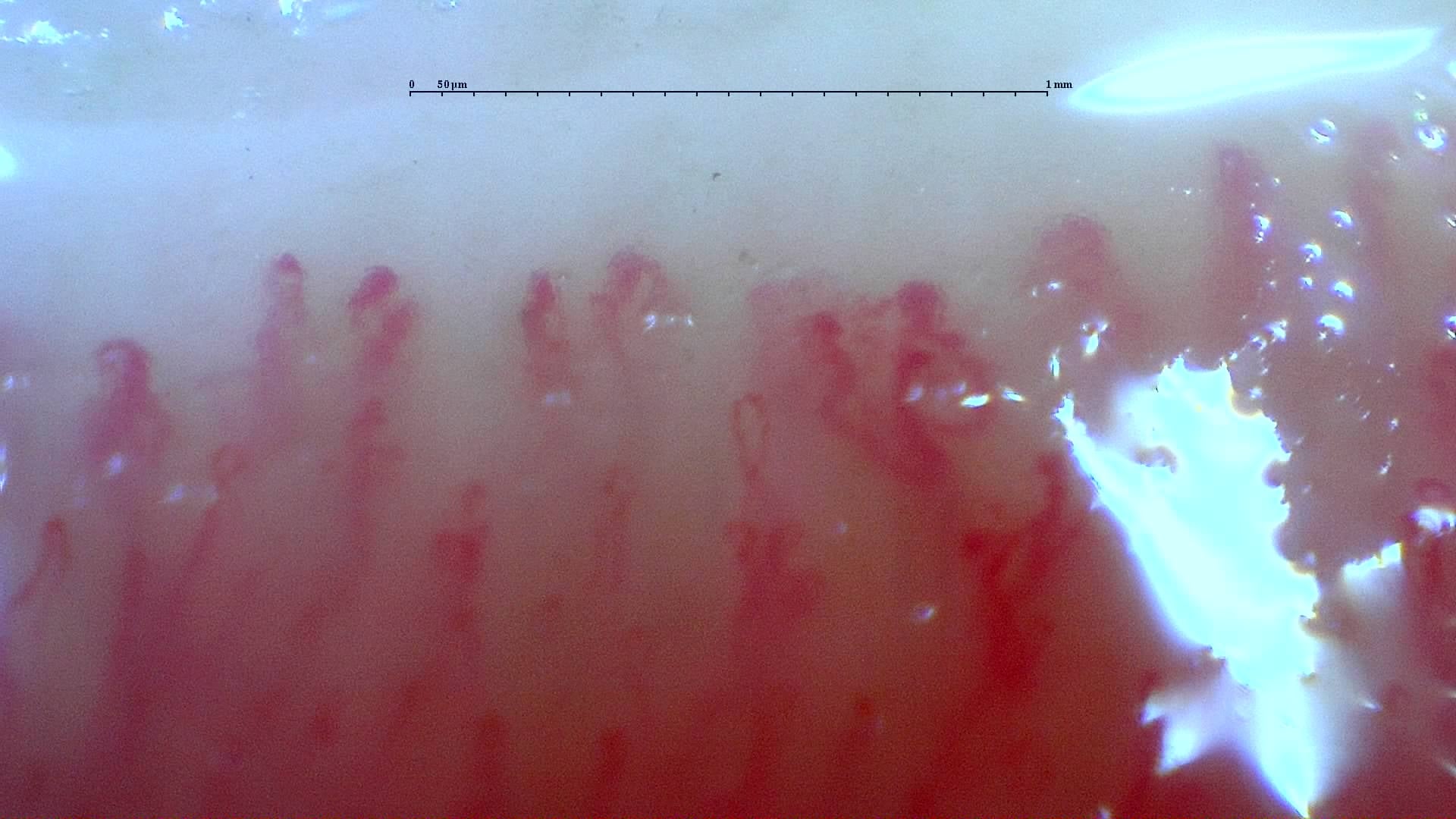 Nailfold capillaroscopy: right little finger, field a. Mixed Connective Tissue Disease with an Unclassifiable Scleroderma-Like Pattern.