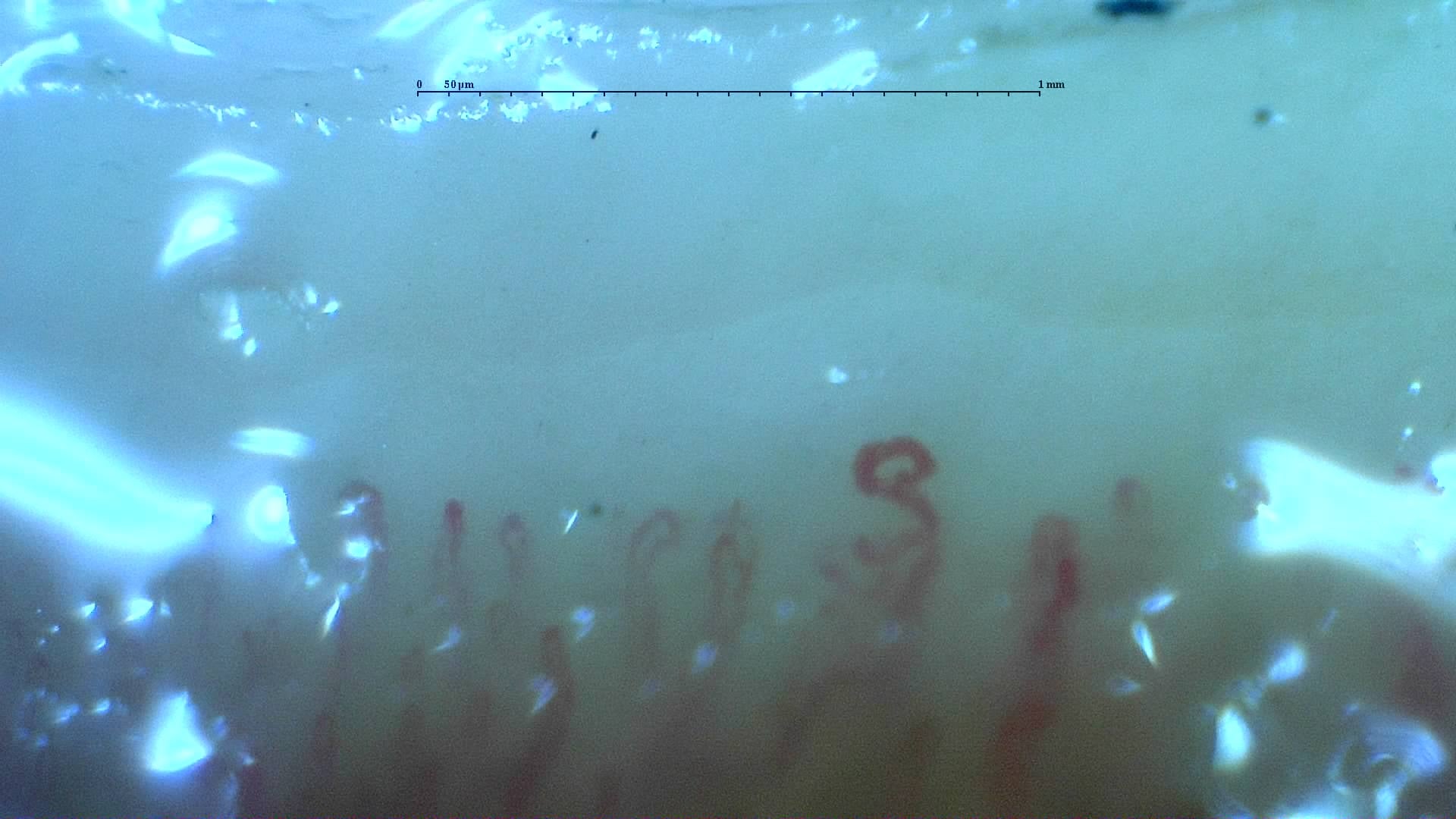 Nailfold capillaroscopy: right middle finger, field a. Mixed Connective Tissue Disease with an Unclassifiable Scleroderma-Like Pattern.