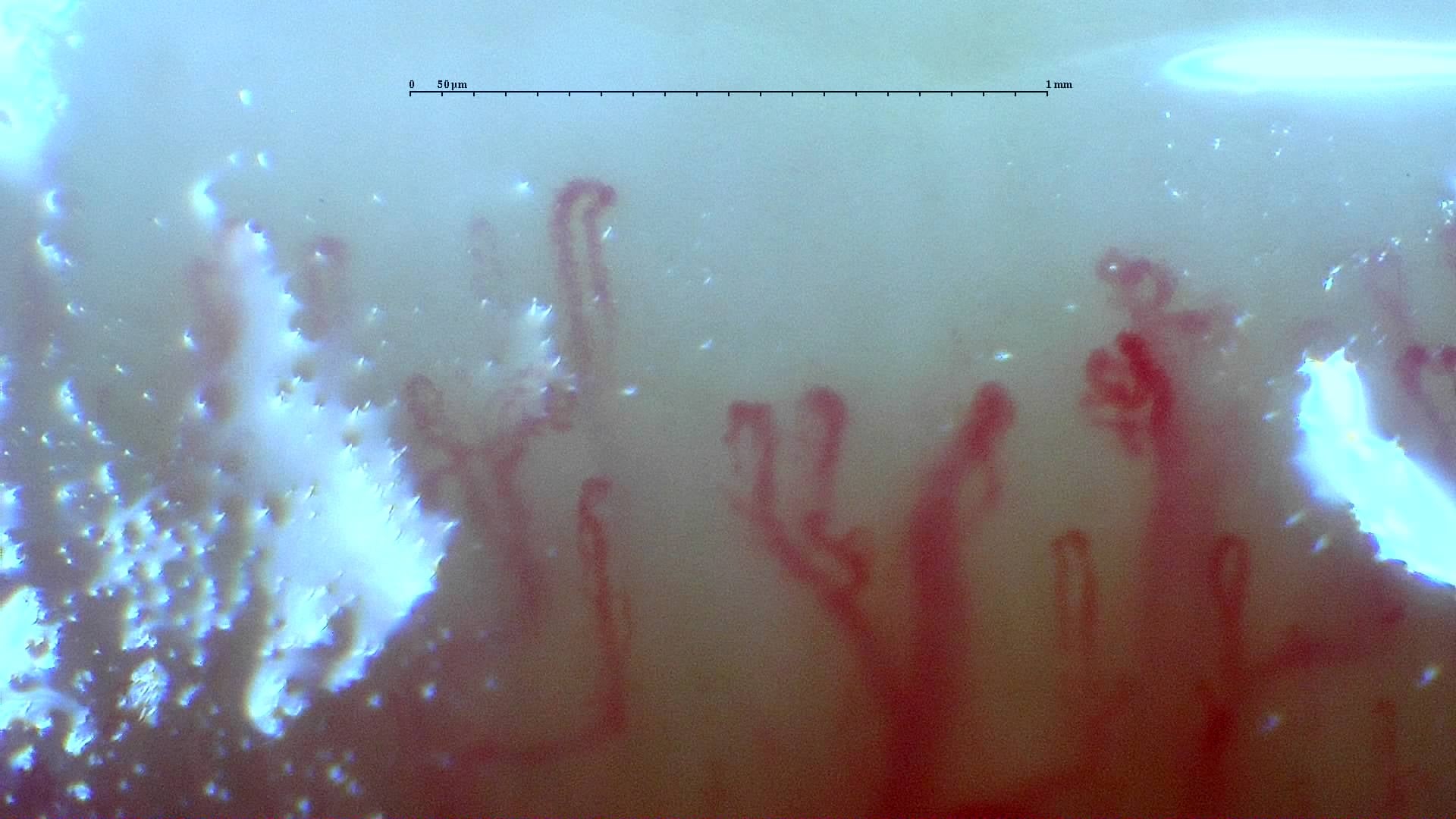 Nailfold capillaroscopy: left ring finger, field d. Mixed Connective Tissue Disease with an Unclassifiable Scleroderma-Like Pattern.