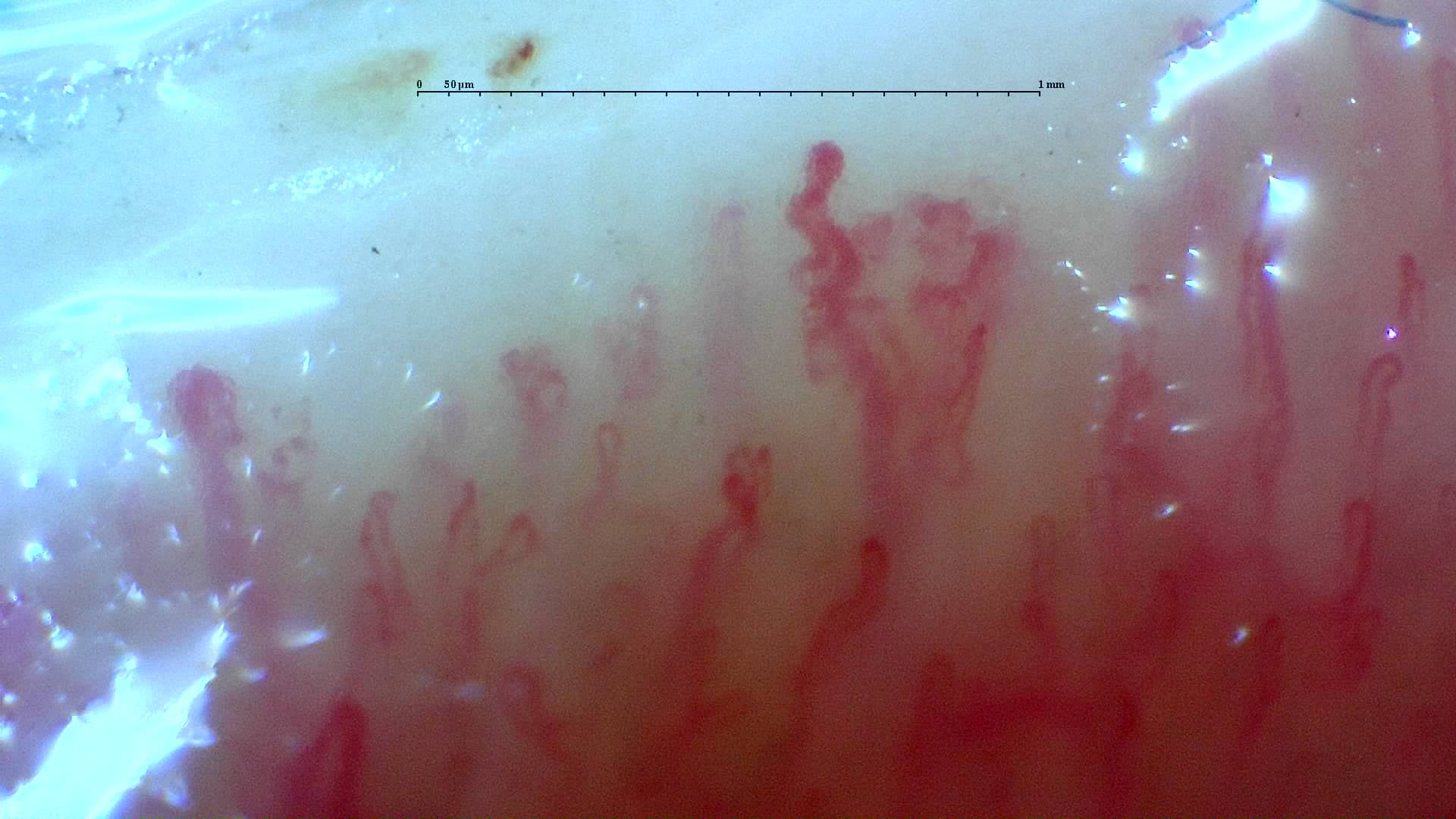 Nailfold capillaroscopy: left ring finger, field a. Mixed Connective Tissue Disease with an Unclassifiable Scleroderma-Like Pattern.