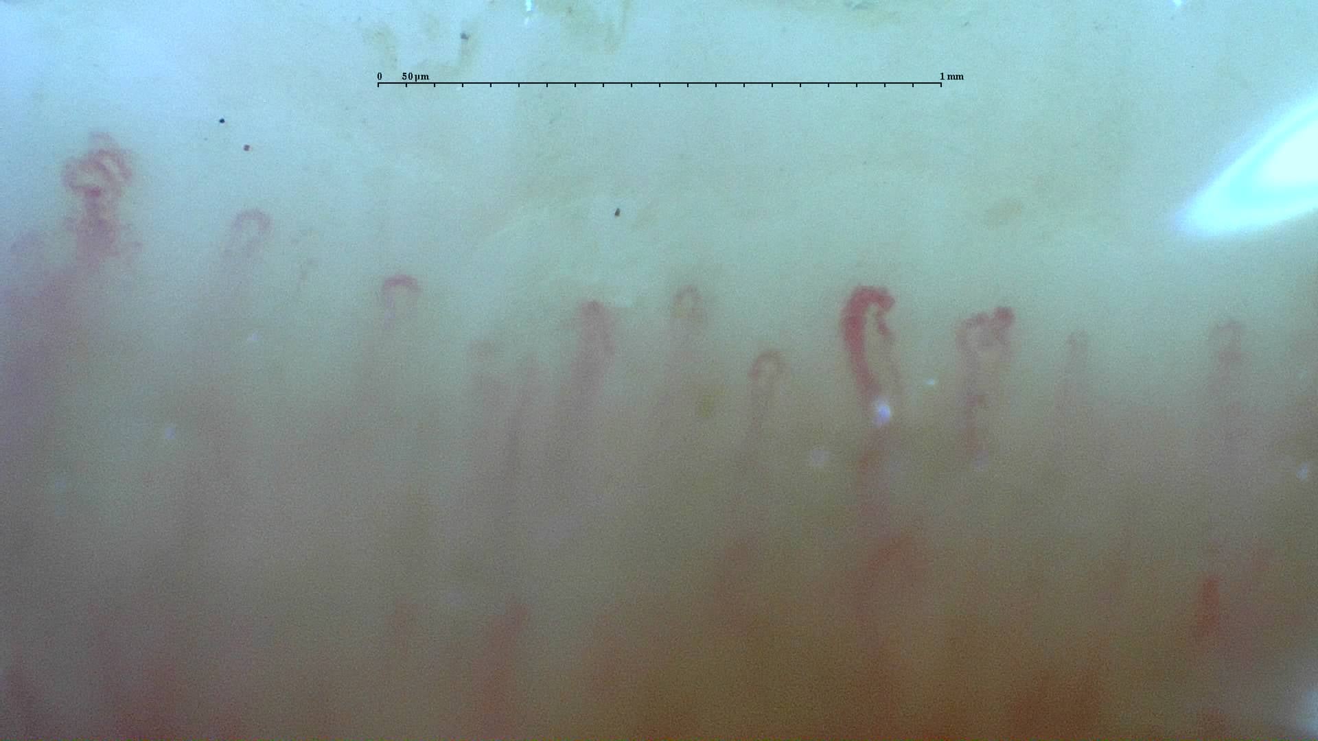 Nailfold capillaroscopy: left middle finger, field b. Mixed Connective Tissue Disease with an Unclassifiable Scleroderma-Like Pattern.