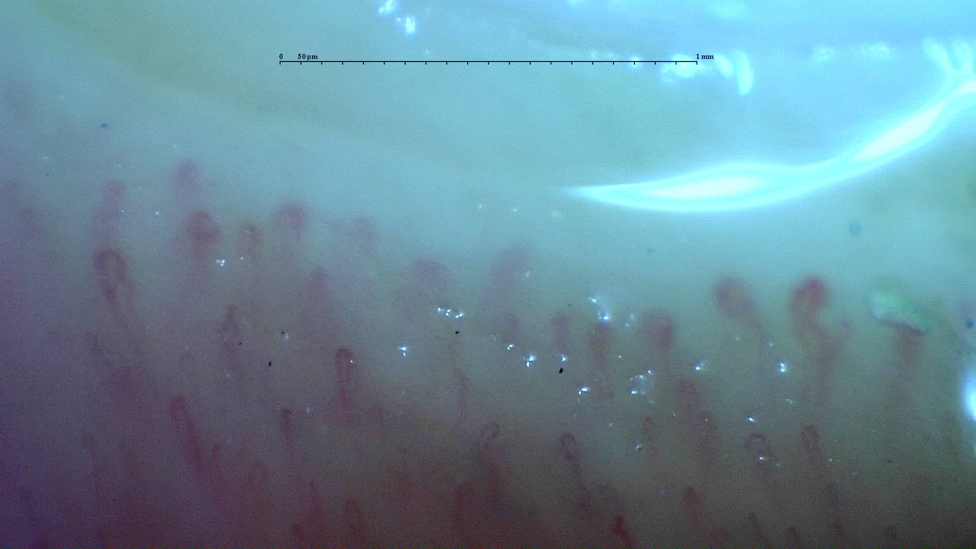 Nailfold capillaroscopy: right index finger, field d. Mixed Connective Tissue Disease with an Unclassifiable Scleroderma-Like Pattern.