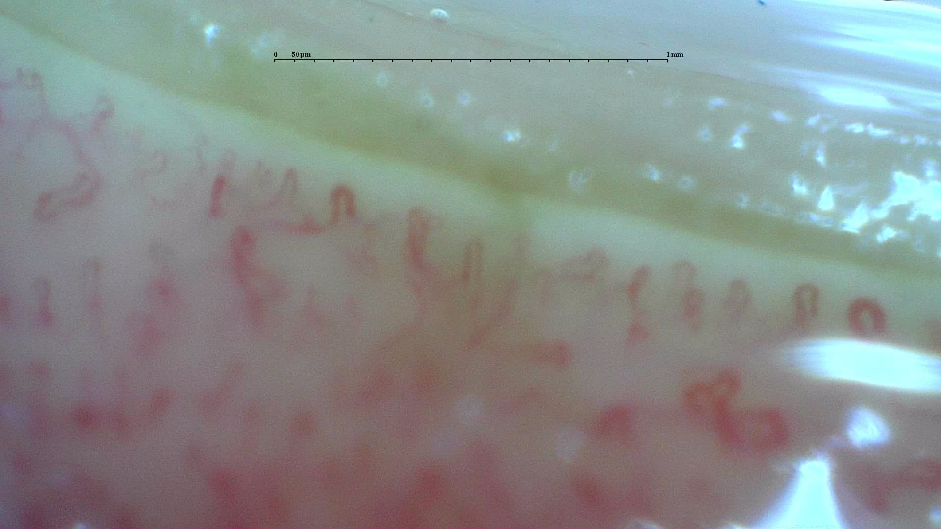 Nailfold capillaroscopy: left middle finger, field c. Anticentromere-Positive Systemic Sclerosis with Inter-Digit Pattern Heterogeneity.