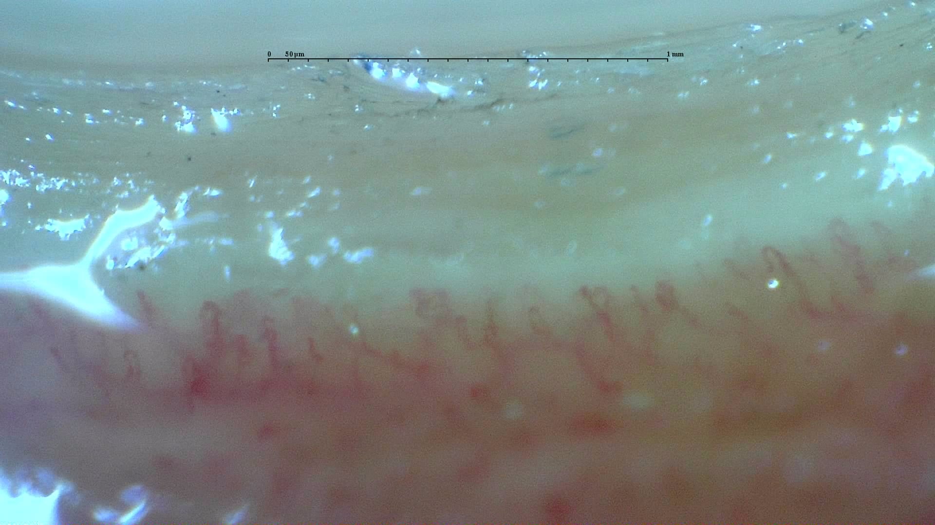 Nailfold capillaroscopy: right middle finger, field b. Anticentromere-Positive Systemic Sclerosis with Inter-Digit Pattern Heterogeneity.