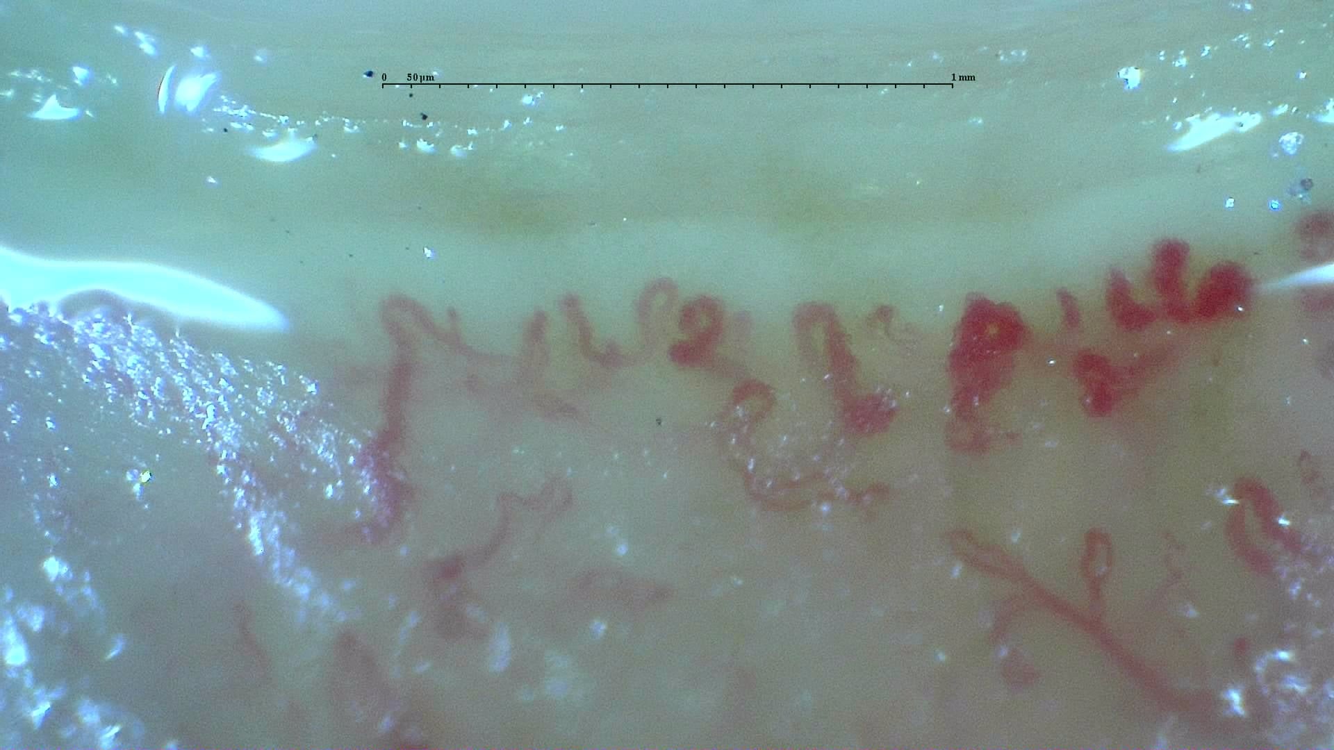 Nailfold capillaroscopy: right ring finger, field b. Anticentromere-Positive Systemic Sclerosis with Inter-Digit Pattern Heterogeneity.