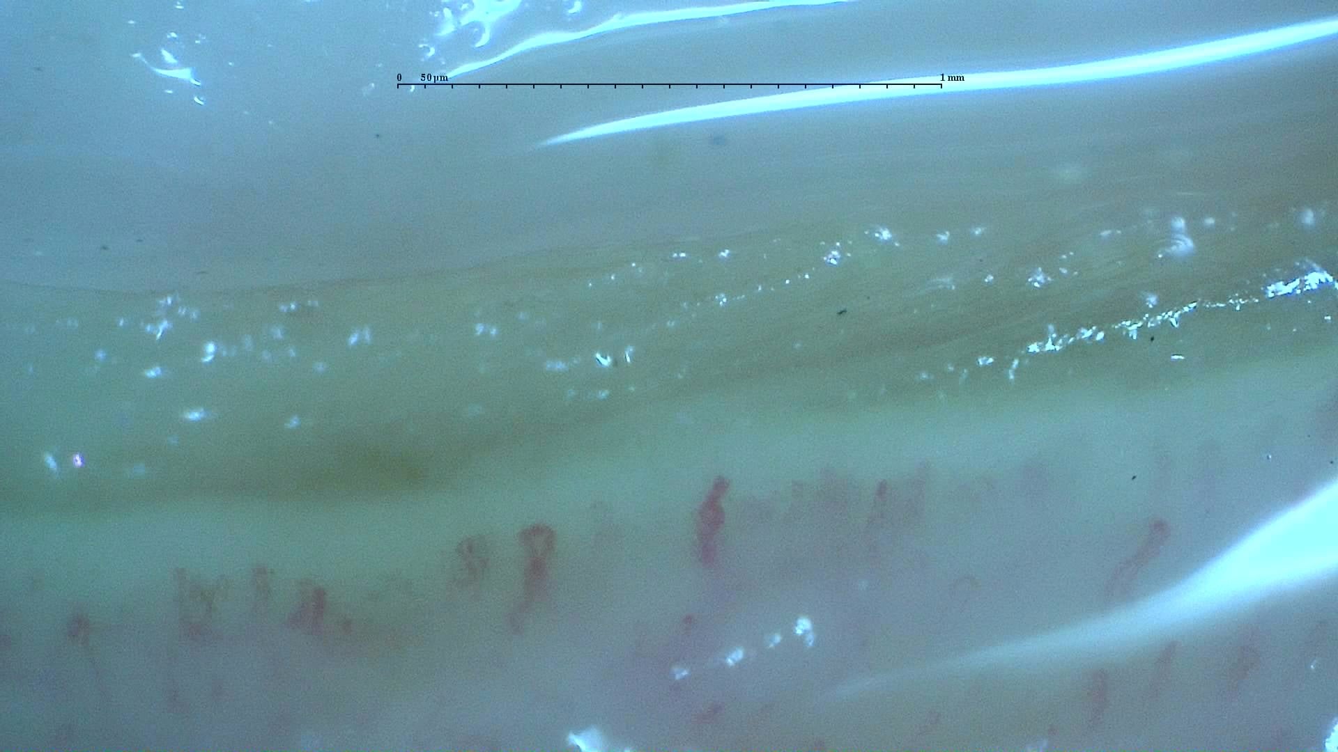 Nailfold capillaroscopy: left ring finger, field a. Anticentromere-Positive Systemic Sclerosis with Inter-Digit Pattern Heterogeneity.