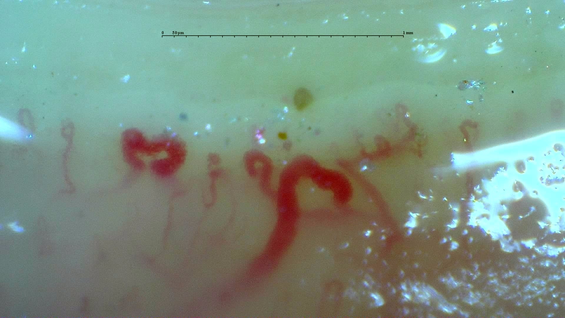 Preview image for Anticentromere-Positive Systemic Sclerosis with Inter-Digit Pattern Heterogeneity