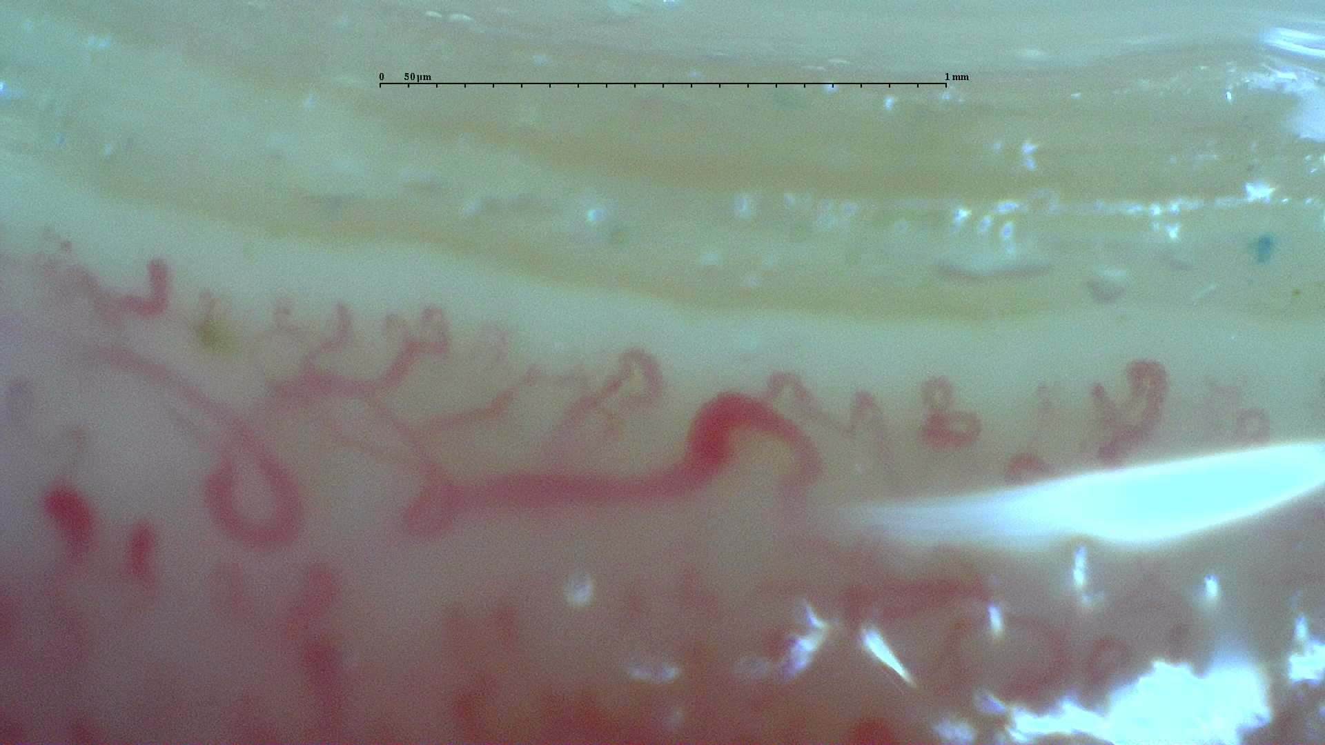 Nailfold capillaroscopy: left index finger, field b. Anticentromere-Positive Systemic Sclerosis with Inter-Digit Pattern Heterogeneity.