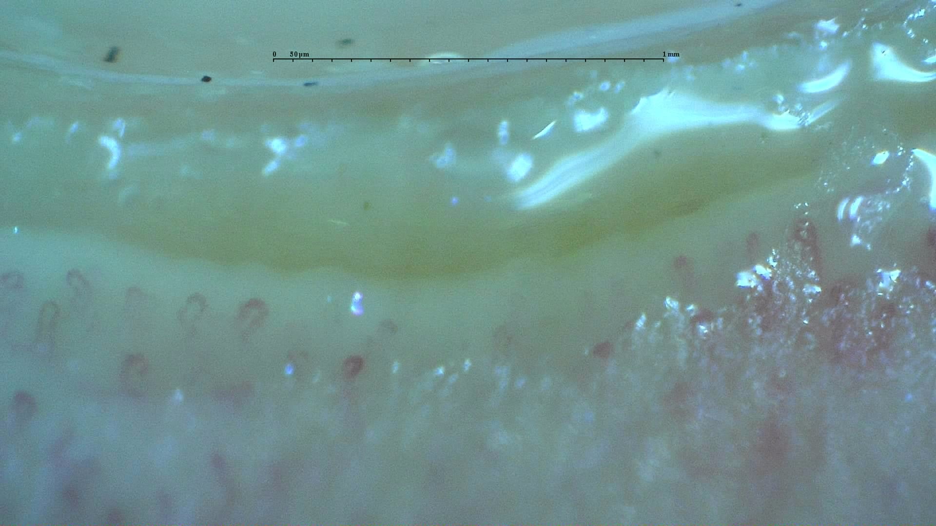 Nailfold capillaroscopy: left index finger, field a. Anticentromere-Positive Systemic Sclerosis with Inter-Digit Pattern Heterogeneity.