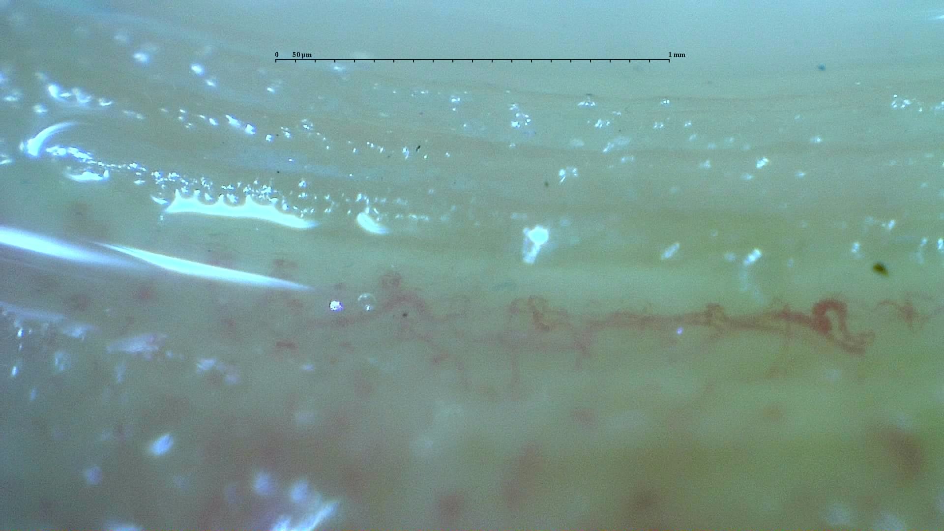 Nailfold capillaroscopy: right index finger, field c. Anticentromere-Positive Systemic Sclerosis with Inter-Digit Pattern Heterogeneity.