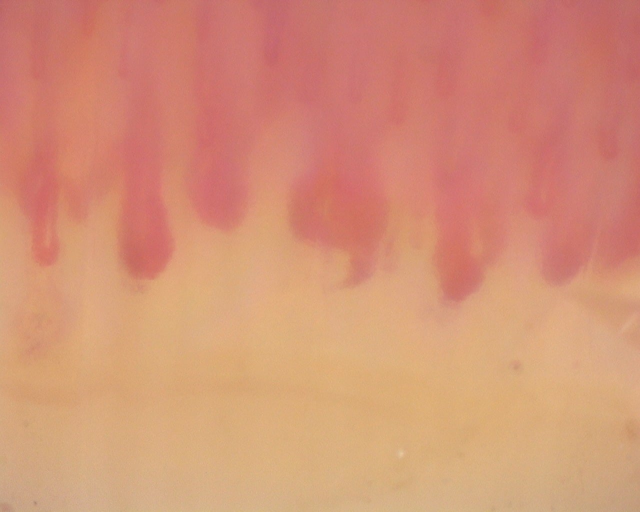 Nailfold capillaroscopy: left index finger, field b. Diffuse Systemic Sclerosis (Anti-Scl-70+) with Active Cutolo Pattern.