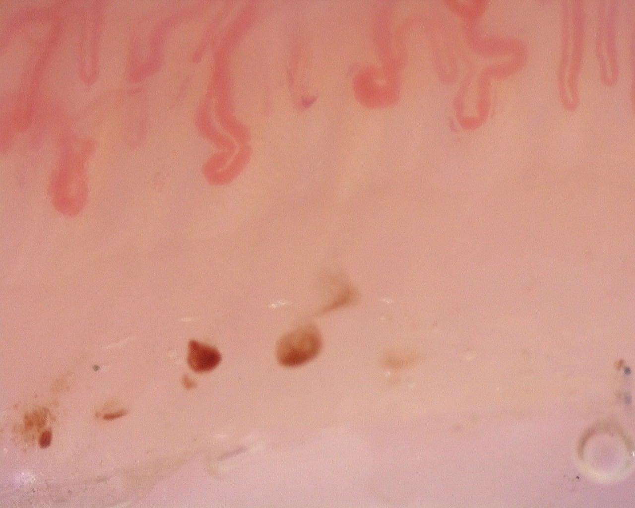 Nailfold capillaroscopy: left ring finger, field b. Diffuse Systemic Sclerosis (Anti-Scl-70+) with Active Cutolo Pattern.