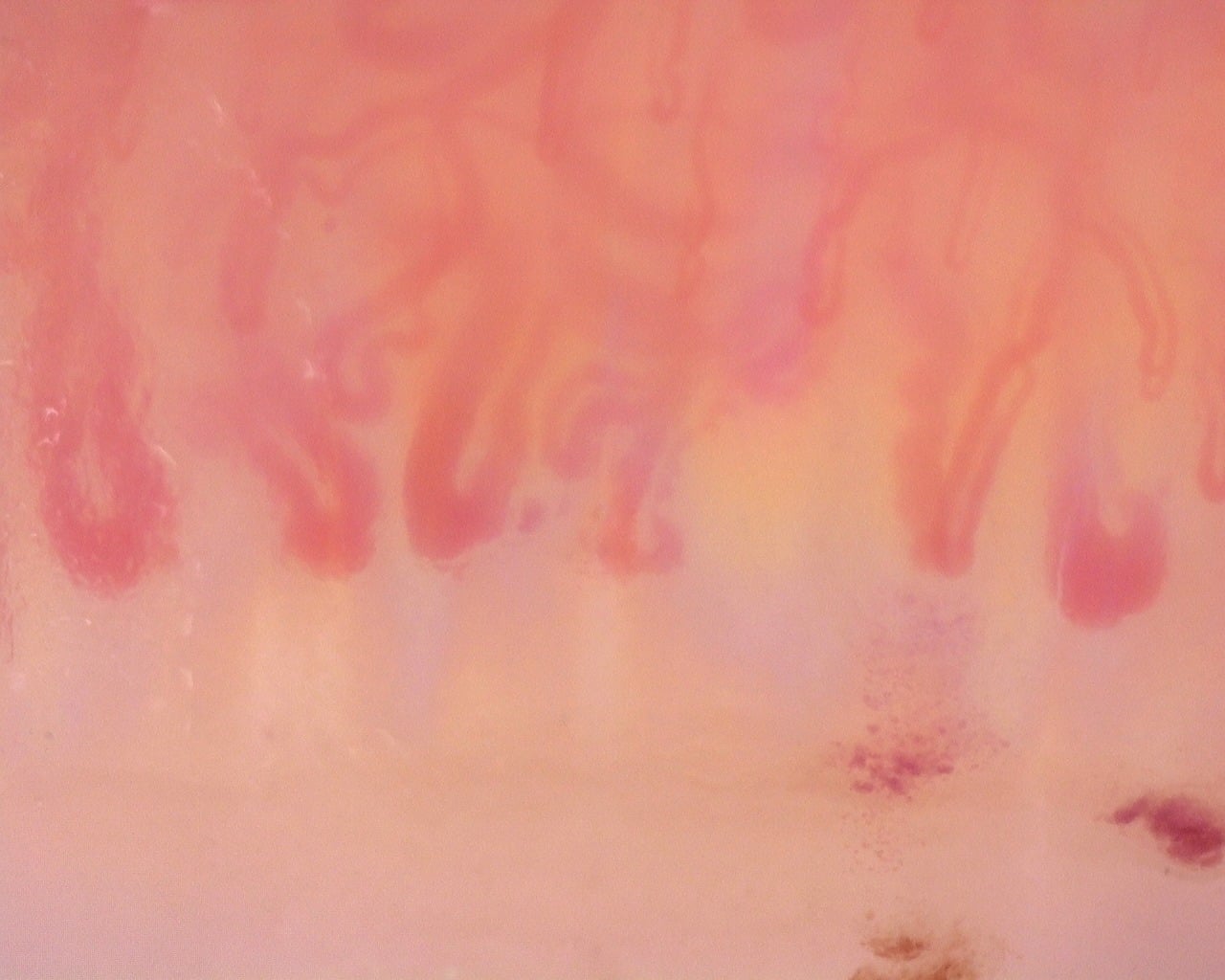 Nailfold capillaroscopy: left ring finger, field b. Diffuse Systemic Sclerosis (Anti-Scl-70+) with Active Cutolo Pattern.