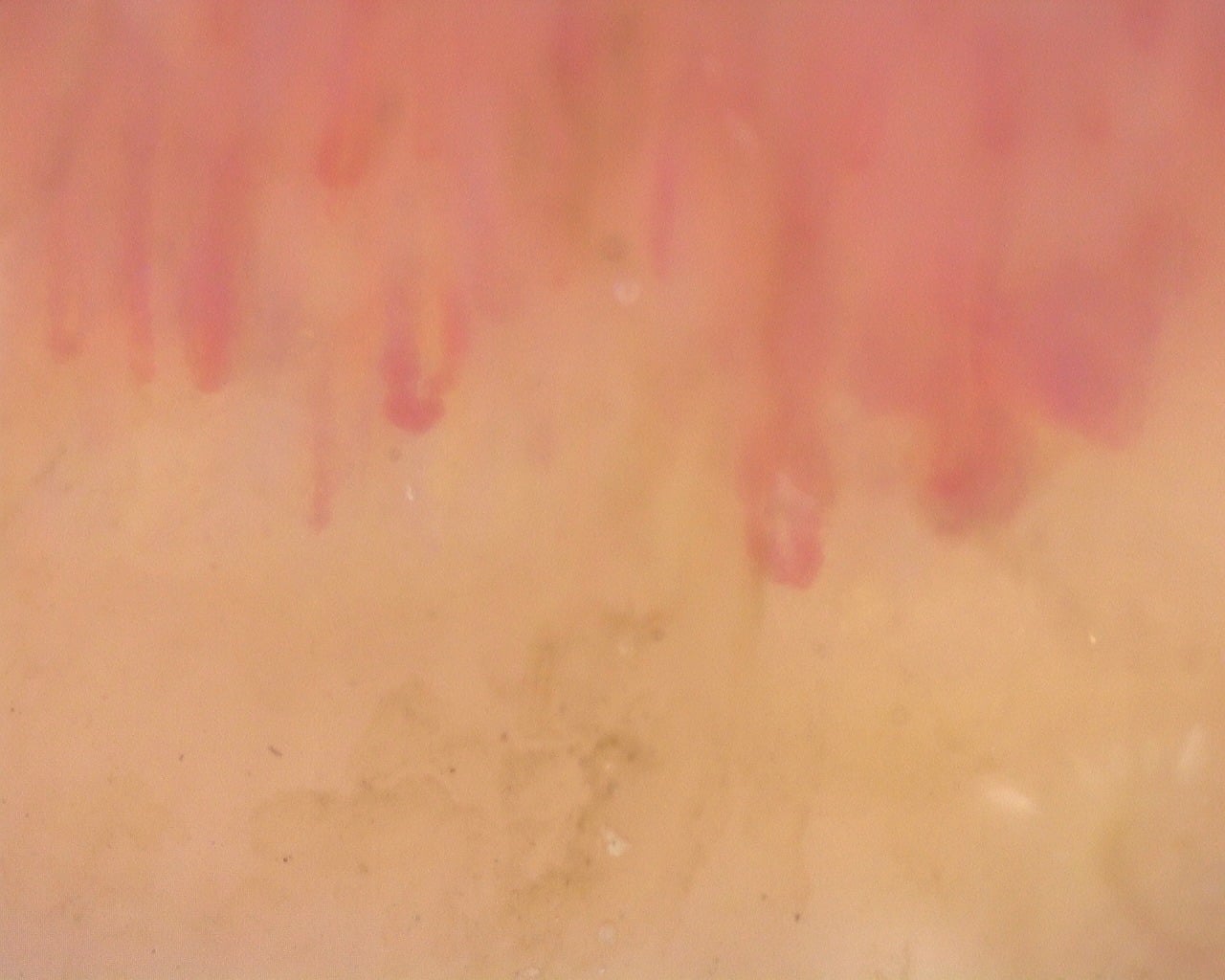 Nailfold capillaroscopy: right index finger, field d. Diffuse Systemic Sclerosis (Anti-Scl-70+) with Active Cutolo Pattern.