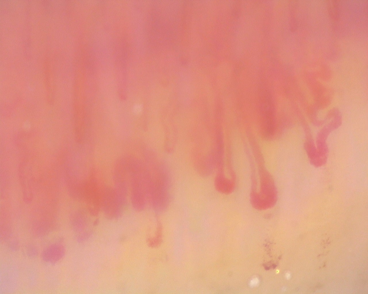 Nailfold capillaroscopy: right ring finger, field d. Diffuse Systemic Sclerosis (Anti-Scl-70+) with Active Cutolo Pattern.