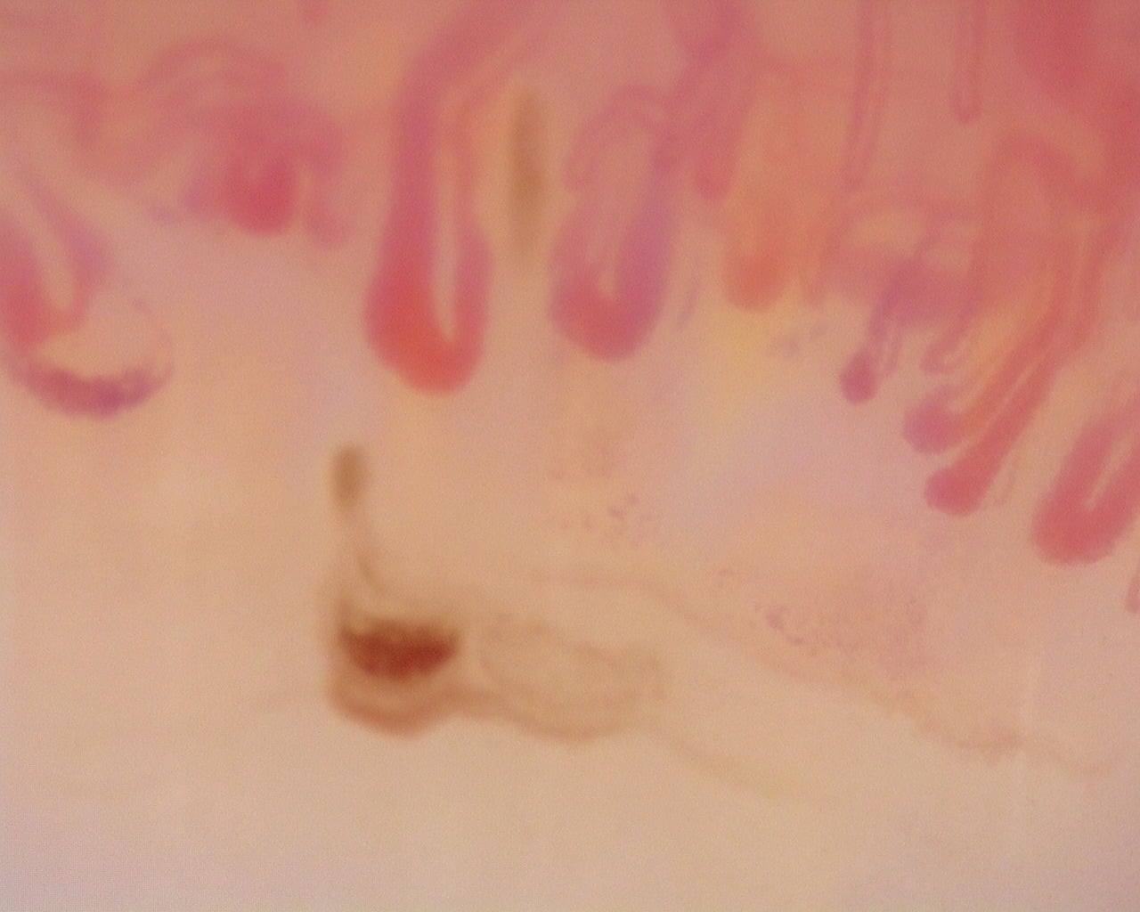 Nailfold capillaroscopy: left little finger, field c. Diffuse Systemic Sclerosis (Anti-Scl-70+) with Active Cutolo Pattern.