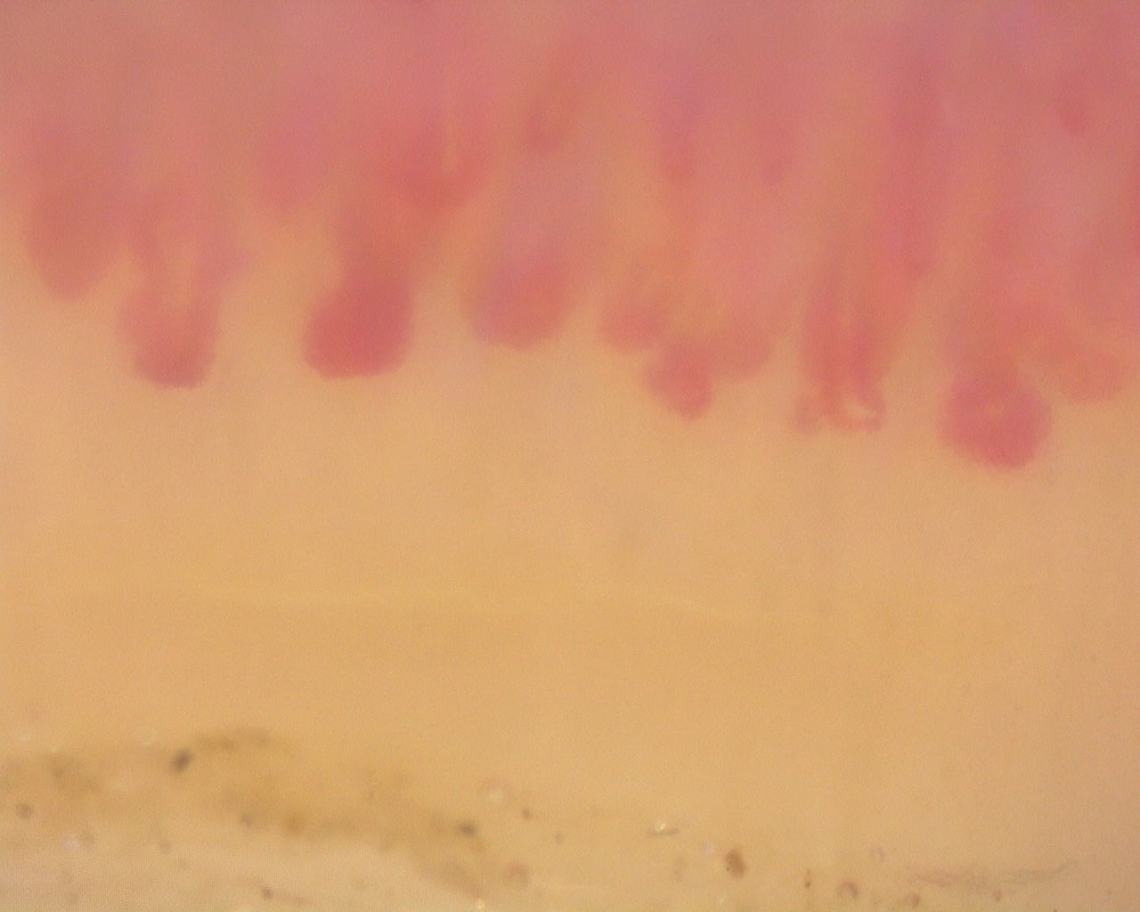 Nailfold capillaroscopy: right index finger, field c. Diffuse Systemic Sclerosis (Anti-Scl-70+) with Active Cutolo Pattern.