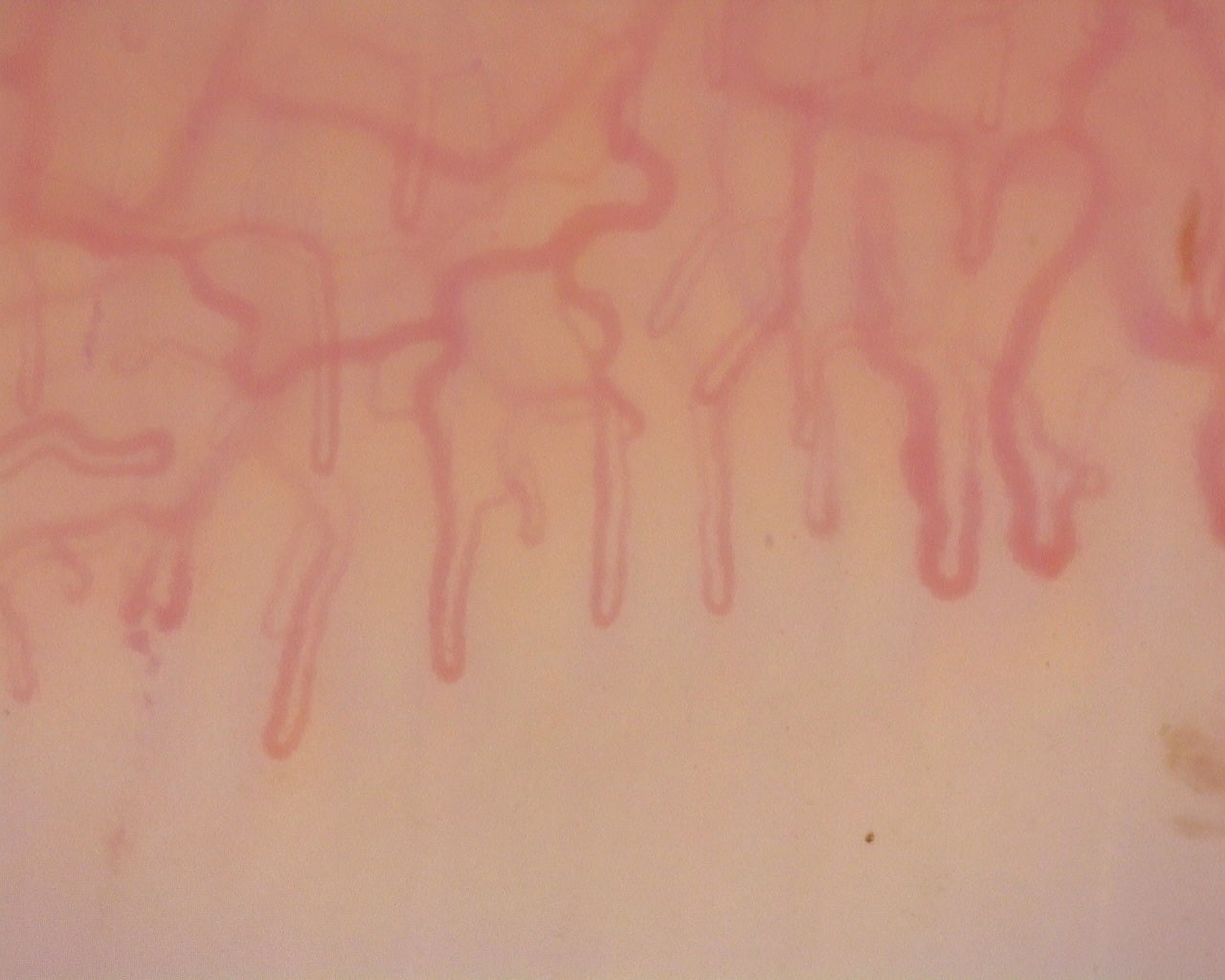 Nailfold capillaroscopy: left little finger, field b. Diffuse Systemic Sclerosis (Anti-Scl-70+) with Active Cutolo Pattern.