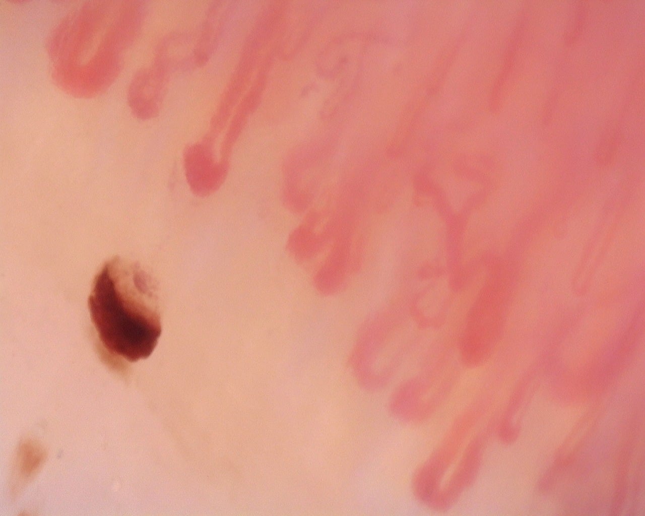 Nailfold capillaroscopy: left ring finger, field d. Diffuse Systemic Sclerosis (Anti-Scl-70+) with Active Cutolo Pattern.